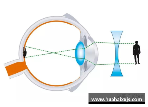 足球明星的近视问题探秘 高度近视对运动表现的影响分析
